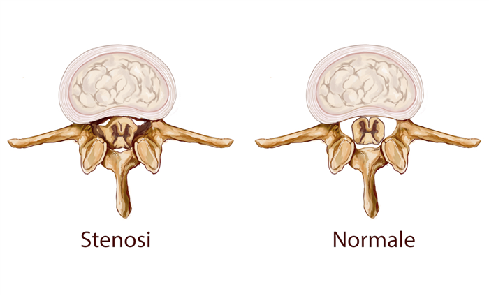 Stenosi vertebrale