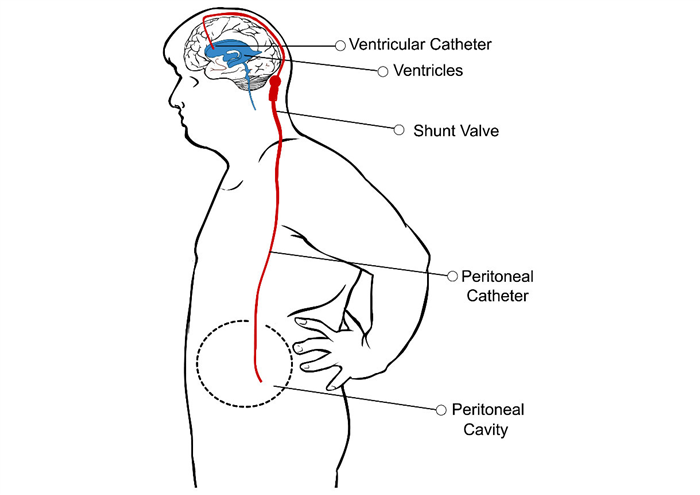 Derivazione ventricolo-peritoneale - schema